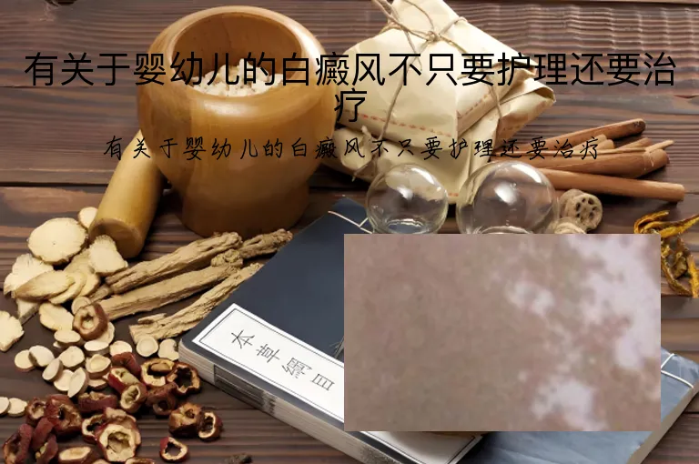 有关于婴幼儿的白癜风不只要护理还要治疗