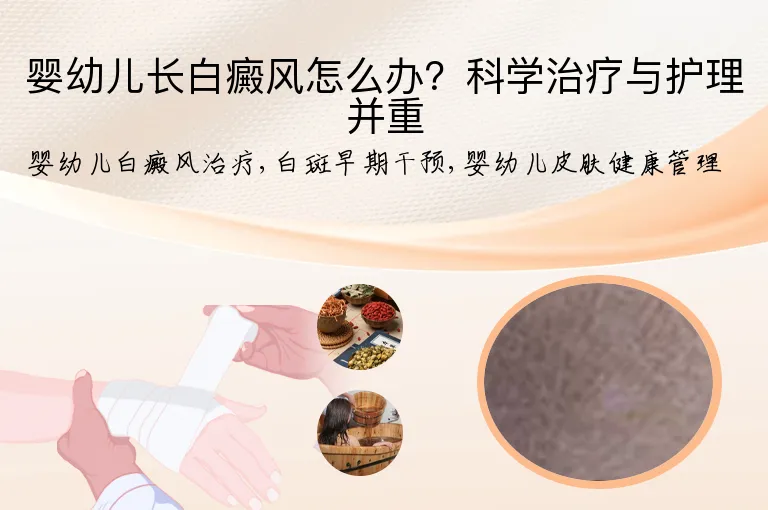 婴幼儿长白癜风怎么办？科学治疗与护理并重
