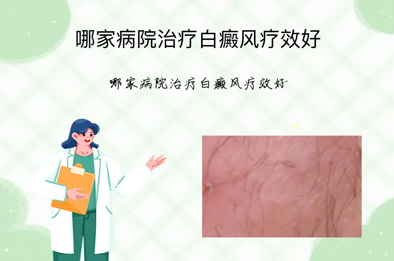 哪家病院治疗白癜风疗效好