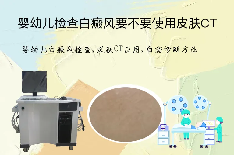 婴幼儿检查白癜风要不要使用皮肤CT