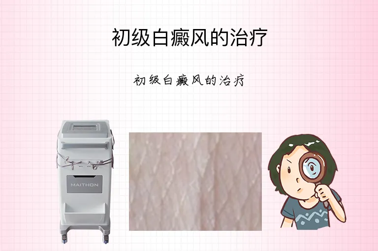 初级白癜风的治疗