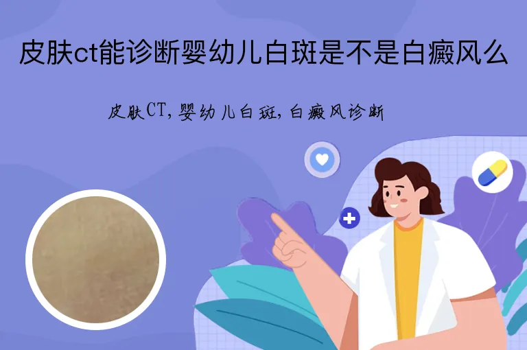皮肤ct能诊断婴幼儿白斑是不是白癜风么