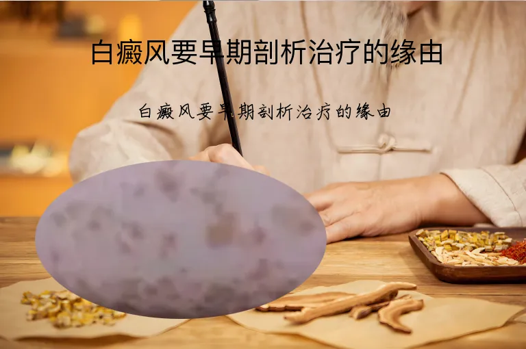白癜风要早期剖析治疗的缘由