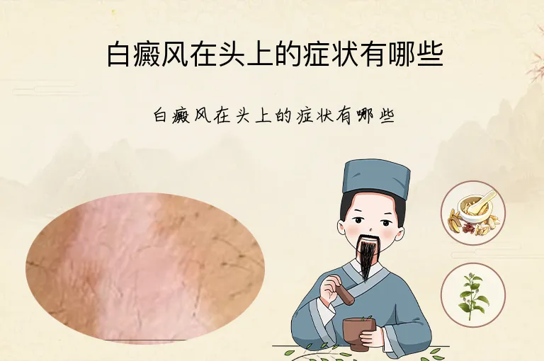 白癜风在头上的症状有哪些