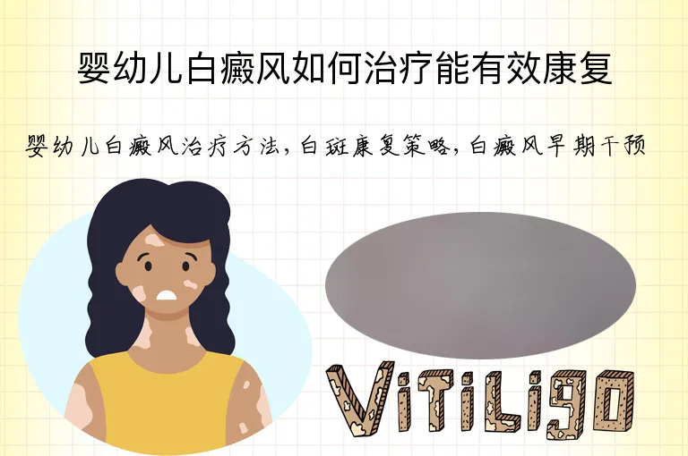 婴幼儿白癜风如何治疗能有效康复