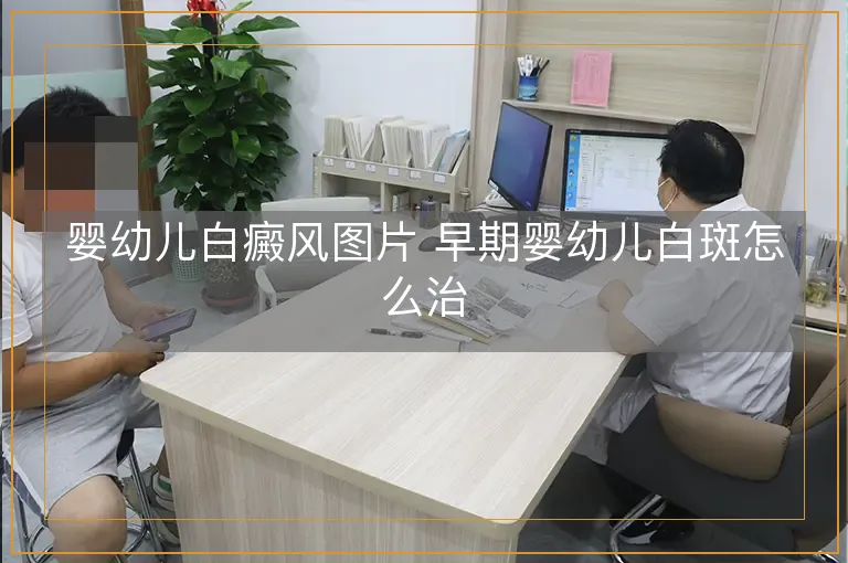 婴幼儿白癜风图片 早期婴幼儿白斑怎么治