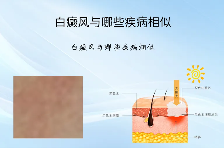 白癜风与哪些疾病相似