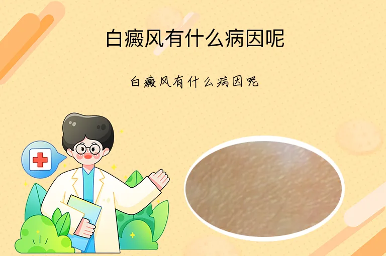 白癜风有什么病因呢