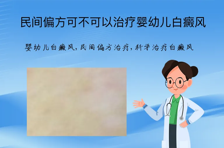 民间偏方可不可以治疗婴幼儿白癜风
