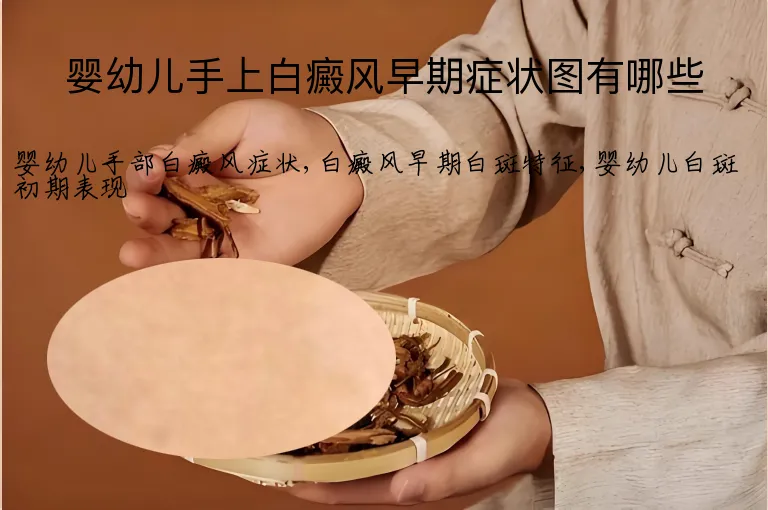 婴幼儿手上白癜风早期症状图有哪些