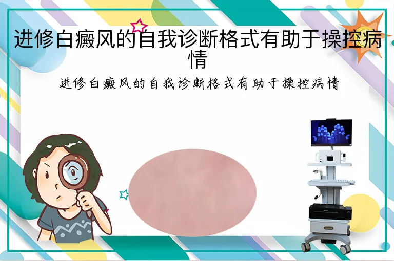 进修白癜风的自我诊断格式有助于操控病情