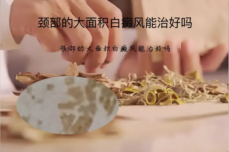 颈部的大面积白癜风能治好吗
