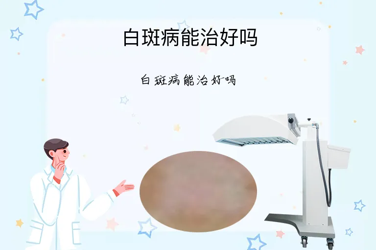 白斑病能治好吗