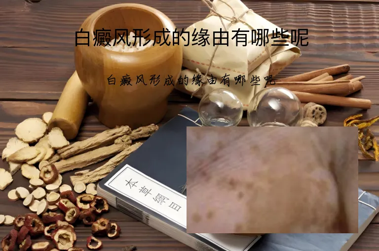 白癜风形成的缘由有哪些呢