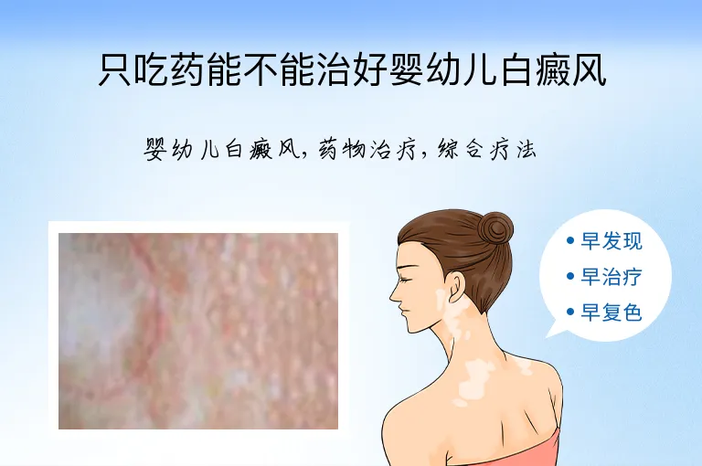 只吃药能不能治好婴幼儿白癜风