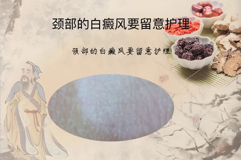 颈部的白癜风要留意护理