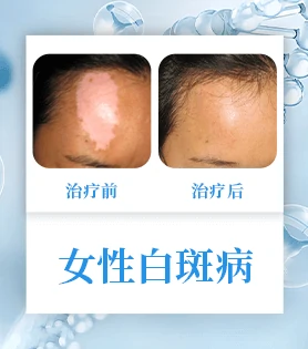 白癜风白斑病